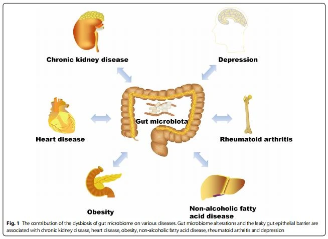 Fig. 1 The contribution of the dysbiosis of gut microbiome on various diseases. Gut microbiome alterations and the leaky gut epithelial barrier are associated with chronic kidney disease, heart disease, obesity, non-alcoholic fatty acid disease, rheumatoid arthritis and depression Fig. 1 The contribution of the dysbiosis of gut microbiome on various diseases. Gut microbiome alterations and the leaky gut epithelial barrier are associated with chronic kidney disease, heart disease, obesity, non-alcoholic fatty acid disease, rheumatoid arthritis and depression